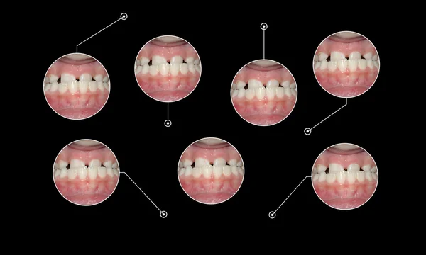 치과 malocclusion underbite 일러스트 그래픽 설정 — 스톡 사진