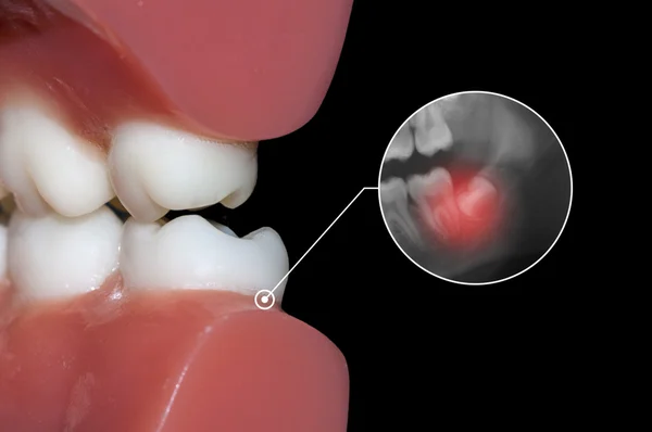 Tandheelkundige infographic wijsheid tand informatie — Stockfoto