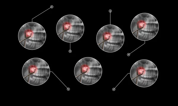 Chirurgia exctraction ząb mądrości graficzne objaśnienia — Zdjęcie stockowe