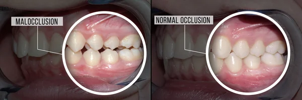 Лечение malocclusion: до и после — стоковое фото