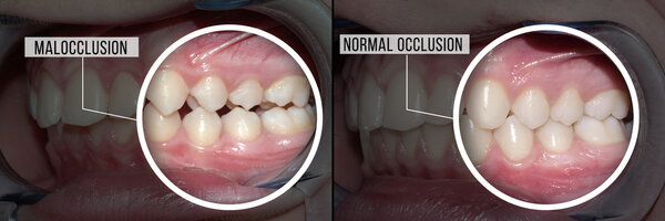 treatment malocclusion: before and after