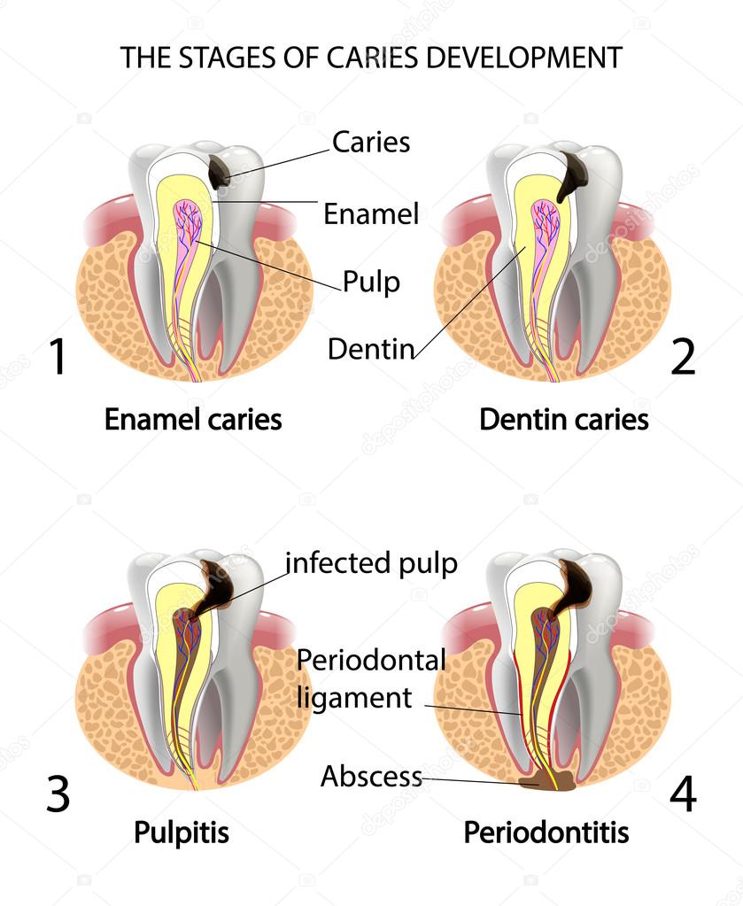 THE STAGES OF CARIES DEVELOPMENT