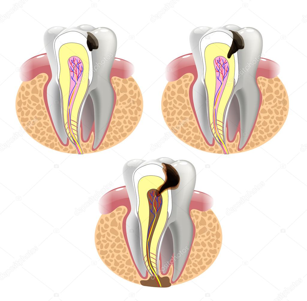 THE STAGES OF CARIES DEVELOPMENT