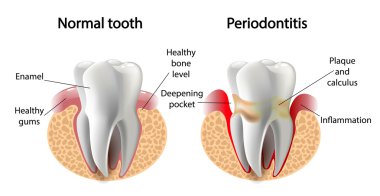 vektör görüntü diş Periodontitis hastalığı