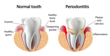 vector image tooth  Periodontitis disease clipart