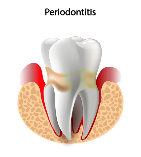 vektör görüntü diş Periodontitis hastalığı