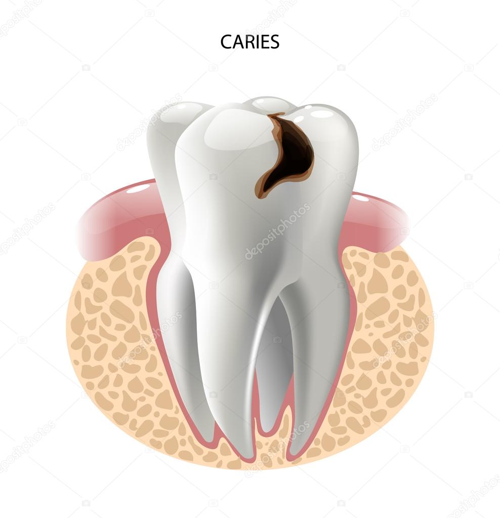 vector image tooth caries disease