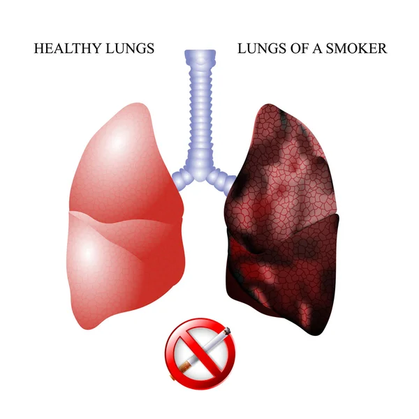 I polmoni di una persona sana e alveoli fumatori — Vettoriale Stock