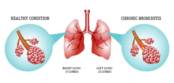 Pulmones, la enfermedad es bronquitis — Vector de stock