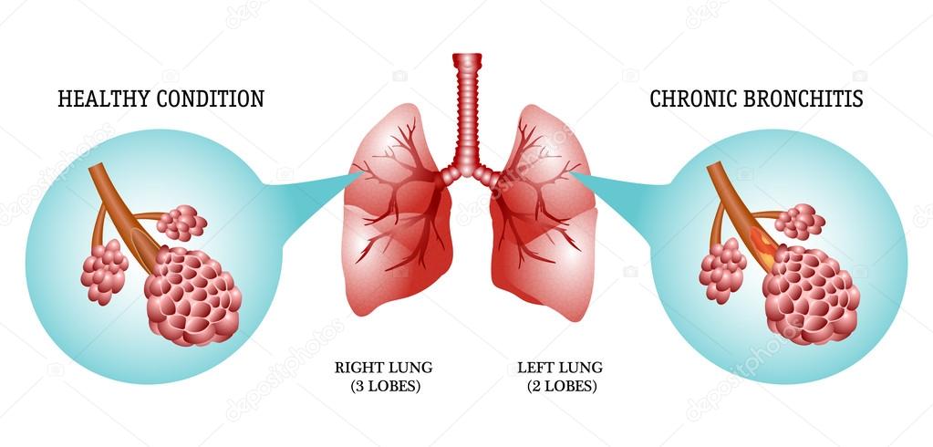 lungs, the disease is bronchitis