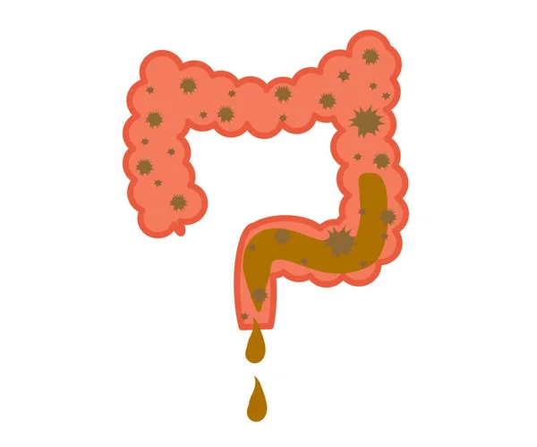 Zieke Darmen Een Witte Achtergrond Diarree Infectie Vectorillustratie — Stockvector