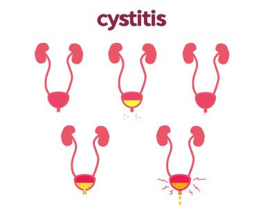 Beyaz arka planda mesane. Sistit. Vektör illüstrasyonu.