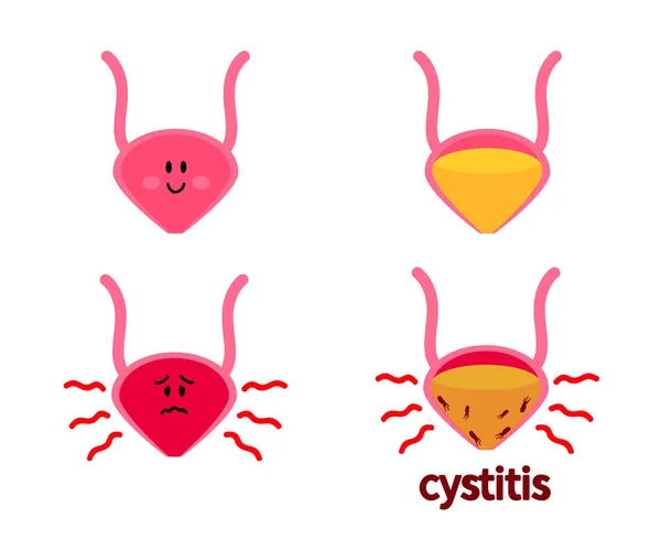 白色背景上的刀片Cystitis 矢量说明 — 图库矢量图片