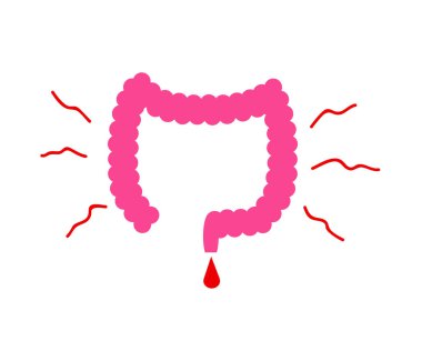 Large intestine on a white background. Constipation. Vector illustration.