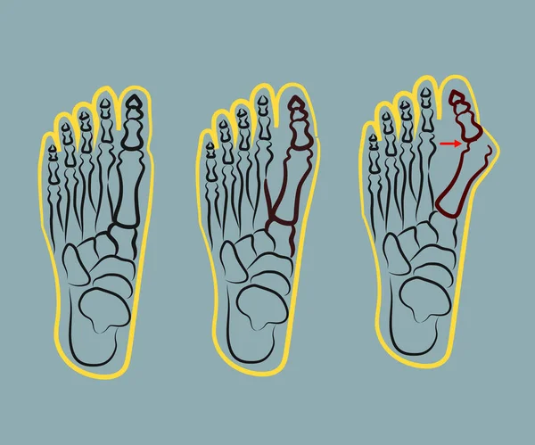 Human Foot Improper Bone Fusion Symbol Vector Illustration — Stock Vector