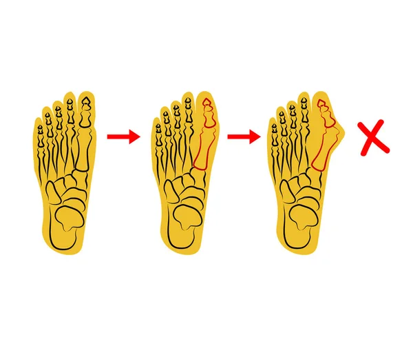 人类的脚不适当的骨融合 矢量说明 — 图库矢量图片