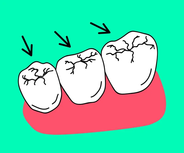 磨牙上的蛀牙人类牙齿牙釉质的破坏 牙科学 卡通片矢量说明 — 图库矢量图片