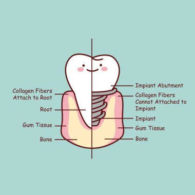 cute cartoon tooth implant anatomy clipart