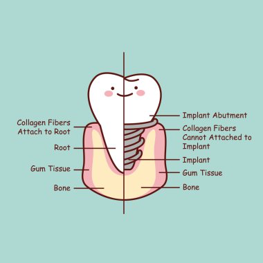 sevimli çizgi diş implantı anatomisi