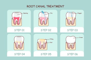 cartoon tooth root canal treatment  clipart