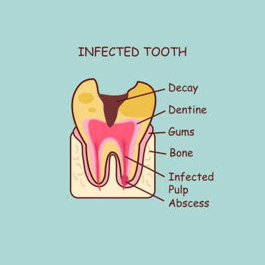 enfekte diş kavramı
