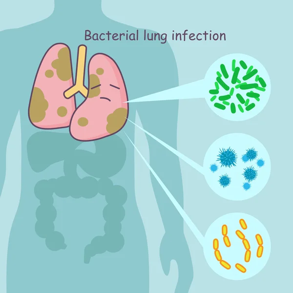 Paru-paru dengan infeksi paru-paru bakteri - Stok Vektor
