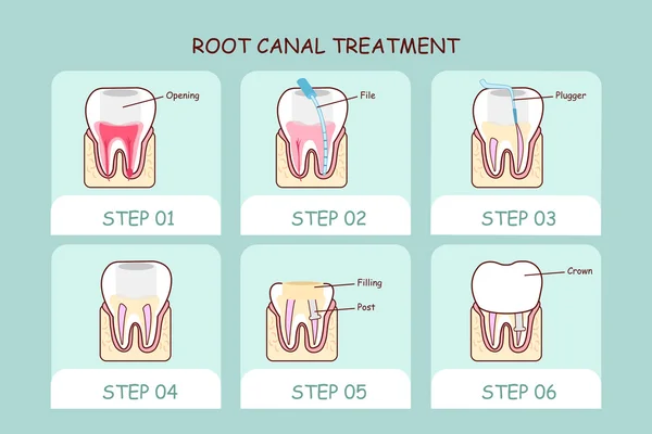 Dessin animé traitement de canal dentaire — Image vectorielle