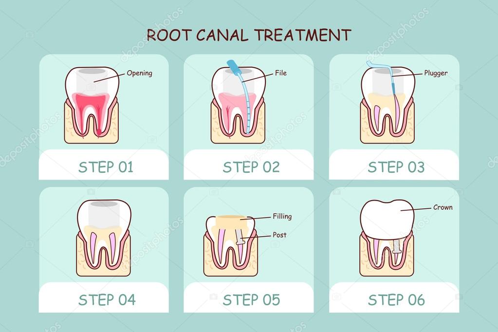 cartoon tooth root canal treatment 