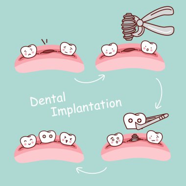 karikatür diş diş implantasyon kavramı