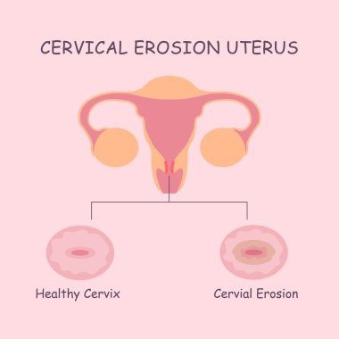 uterus and cervial erosion clipart