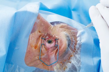 Doktor performans gösteren göz cerrahisi