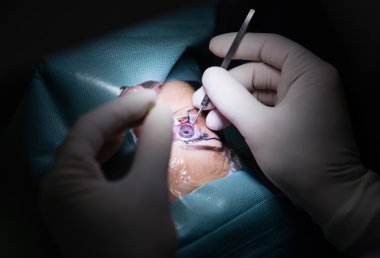 Göz ameliyatı hastanede