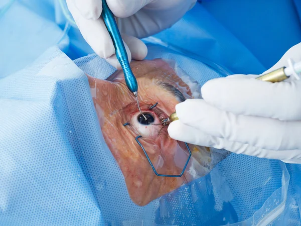 Cirurgia ocular close-up — Fotografia de Stock