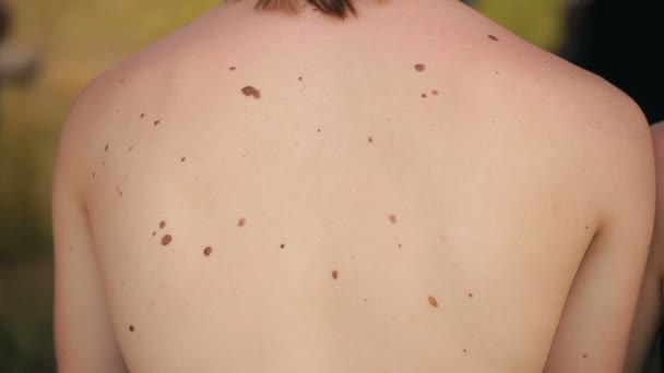 Skin of a man with moles — Stock Video