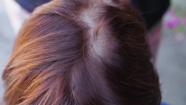 Mujer con problemas de pérdida de cabello — Vídeos de Stock