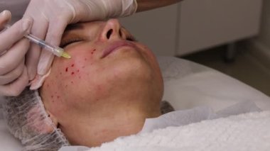 Biyolojik evrim, mezoterapi prosedürü, hiyalüronik asit enjeksiyonları, cilt gelişimi ve gençleştirme, yüz hatlarını düzeltme, güzellik uzmanı ve hasta, yakın çekim.