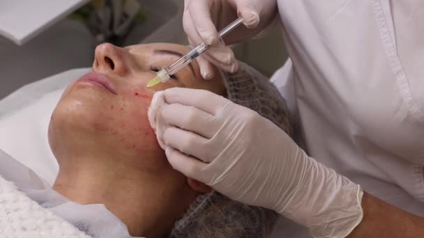 Biorevitalization Mesotherapy Procedure Hyaluronic Acid Injections Skin Improvement Rejuvenation Face — Stock Video
