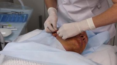 Çok yönlü kesikleri olan çok ince ve dayanıklı iplikleri olan bir erkek hasta için iplik kaldırma.
