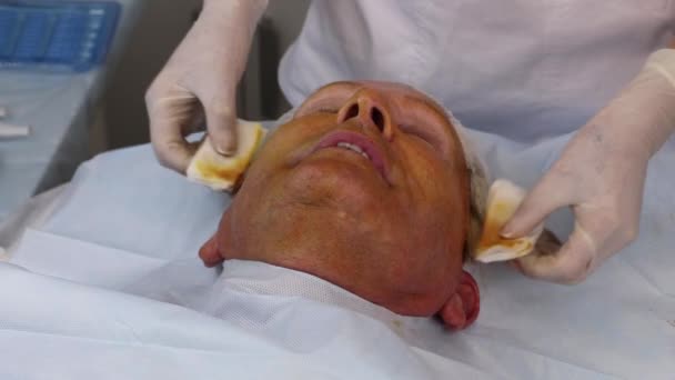 Levantamiento de roscas para un paciente masculino con roscas ultra finas y duraderas con cortes multidireccionales. — Vídeos de Stock