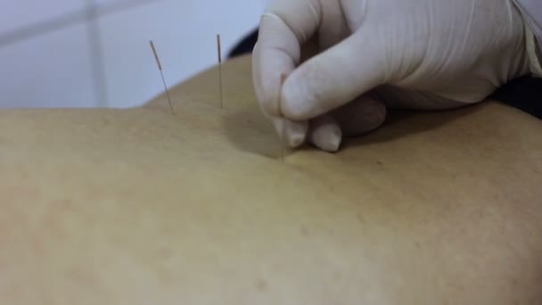 Médico de acupuntura estabelece agulha nas costas — Vídeo de Stock