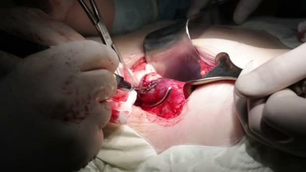 Chirurgie pour éliminer le cancer 