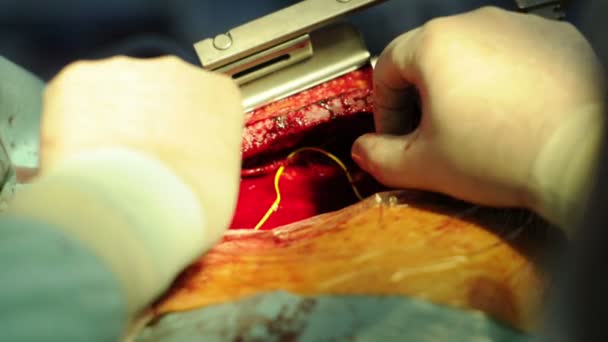 Un medico effettua un'operazione al cuore — Video Stock