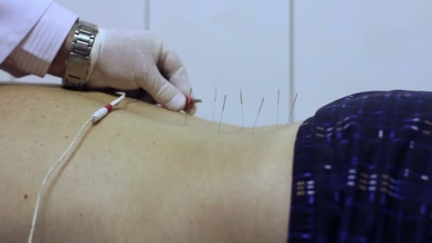 Acupuntura Electro Médica — Vídeo de stock