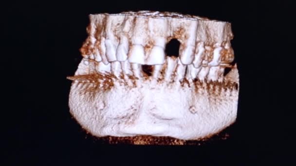 Челюсть пациента на Монито — стоковое видео