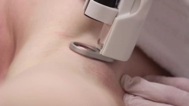 Lazer epilasyon cihazları kullanarak