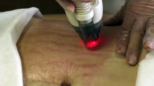 Лазерная обработка кожи — стоковое видео
