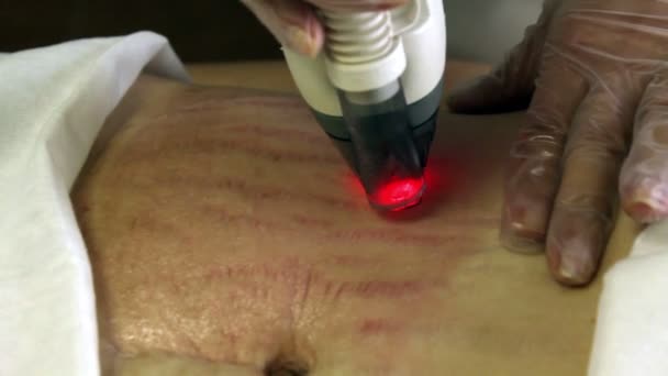 Laser Skin Treatment — Stock Video