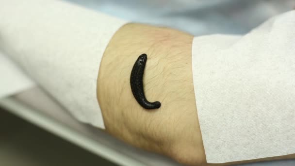 Leech di irudoterapia sul braccio dei pazienti — Video Stock