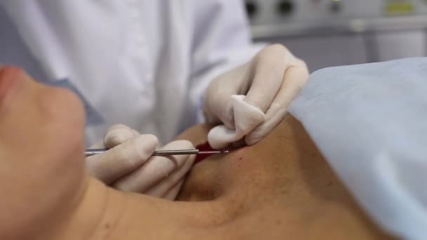 Remoção de toupeiras no corpo de uma mulher — Vídeo de Stock
