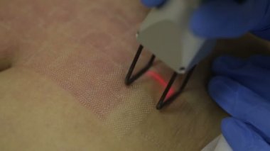 Streç işaretleri kaldırmak için kozmetik prosedürler